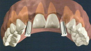 Implant, cabinet dentaire Beucher Moelan sur mer